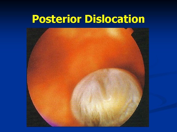 Posterior Dislocation 