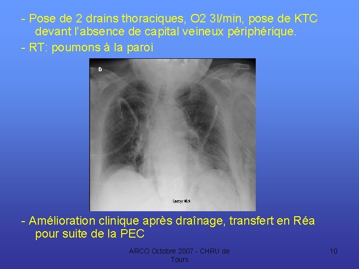 - Pose de 2 drains thoraciques, O 2 3 l/min, pose de KTC devant