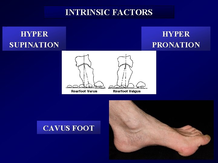 INTRINSIC FACTORS HYPER SUPINATION CAVUS FOOT HYPER PRONATION 