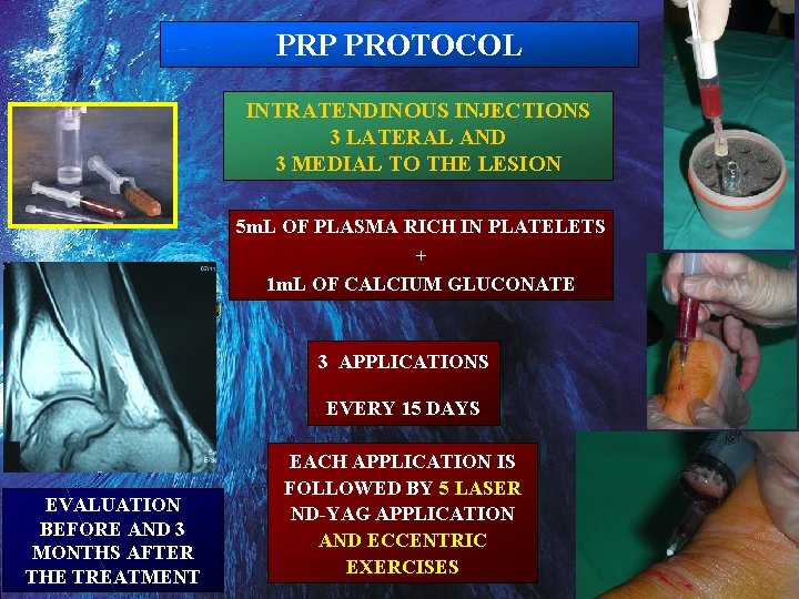 PRP PROTOCOL INTRATENDINOUS INJECTIONS 3 LATERAL AND 3 MEDIAL TO THE LESION 5 m.