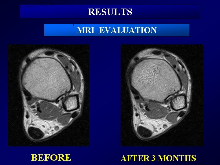 RESULTS MRI EVALUATION BEFORE AFTER 3 MONTHS 