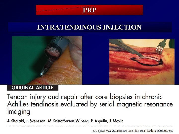 PRP INTRATENDINOUS INJECTION * TENDON LESION * GROW FACTORS WITH ANGIOGENETIC FACTORS LIKE VEGF
