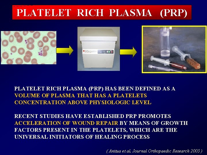 PLATELET RICH PLASMA (PRP) HAS BEEN DEFINED AS A VOLUME OF PLASMA THAT HAS