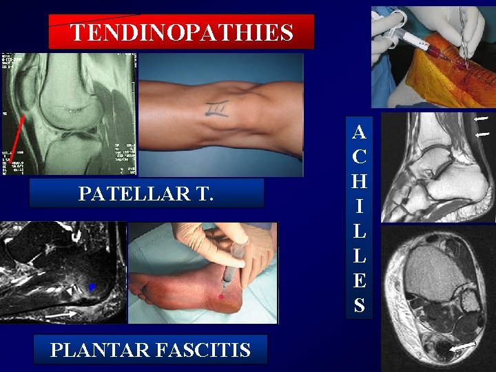 TENDINOPATHIES PATELLAR T. PLANTAR FASCITIS A C H I L L E S 