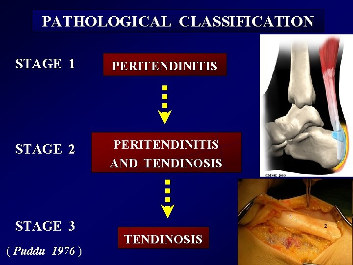 PATHOLOGICAL CLASSIFICATION STAGE 1 PERITENDINITIS STAGE 2 PERITENDINITIS AND TENDINOSIS STAGE 3 ( Puddu