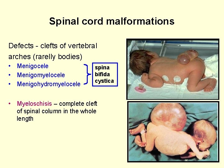 Spinal cord malformations Defects - clefts of vertebral arches (rarelly bodies) • Menigocele •