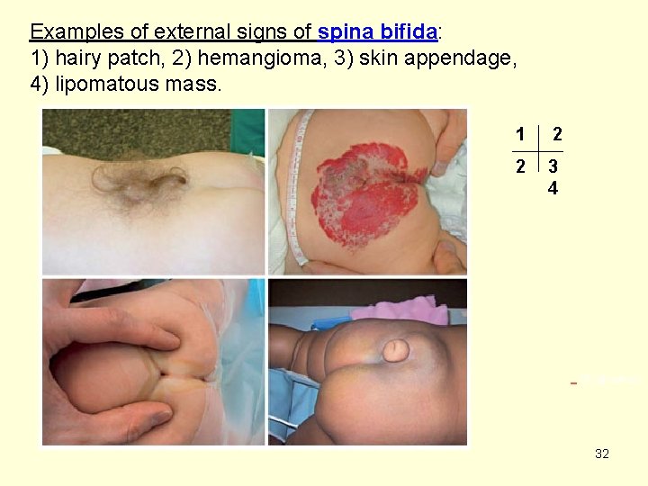 Examples of external signs of spina bifida: 1) hairy patch, 2) hemangioma, 3) skin