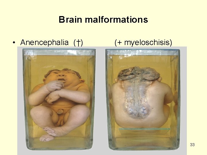 Brain malformations • Anencephalia (†) (+ myeloschisis) 33 