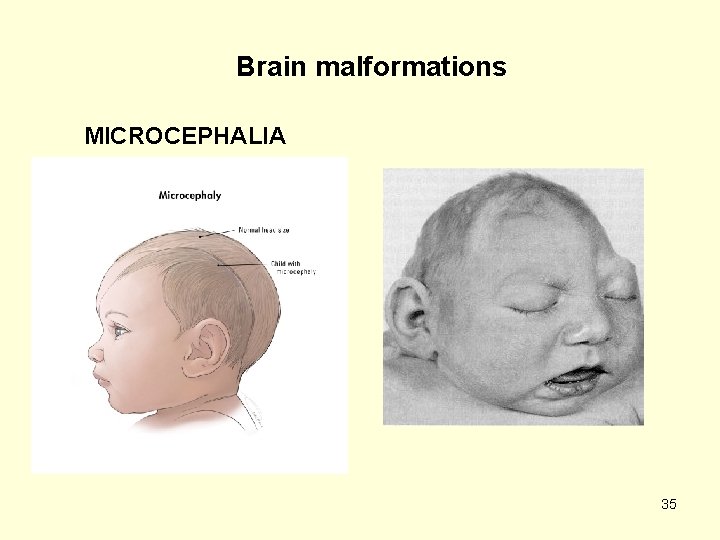 Brain malformations MICROCEPHALIA 35 