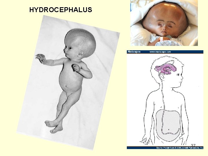 HYDROCEPHALUS 37 