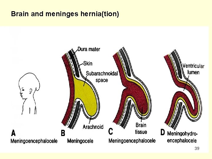 Brain and meninges hernia(tion) 39 