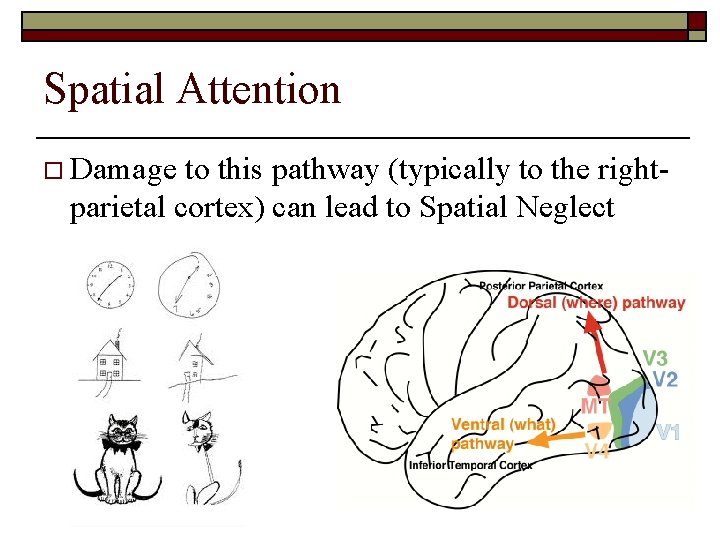 Spatial Attention o Damage to this pathway (typically to the rightparietal cortex) can lead