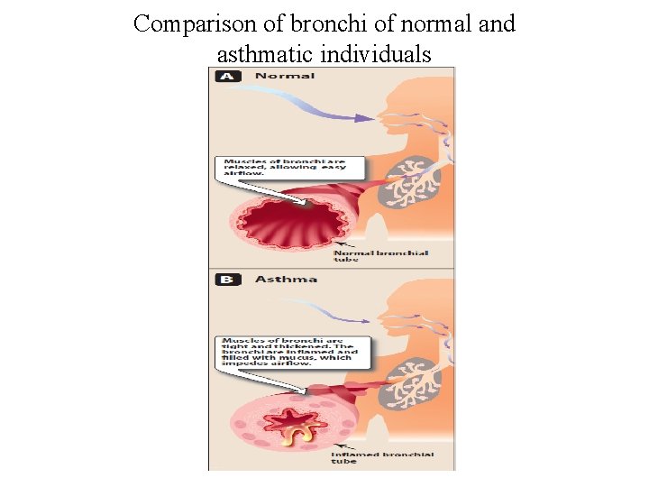 Comparison of bronchi of normal and asthmatic individuals 