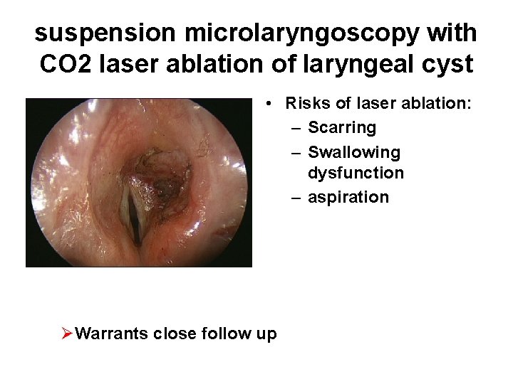 suspension microlaryngoscopy with CO 2 laser ablation of laryngeal cyst • Risks of laser