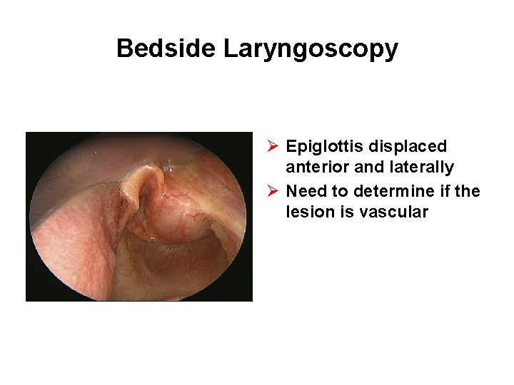 Bedside Laryngoscopy Ø Epiglottis displaced anterior and laterally Ø Need to determine if the