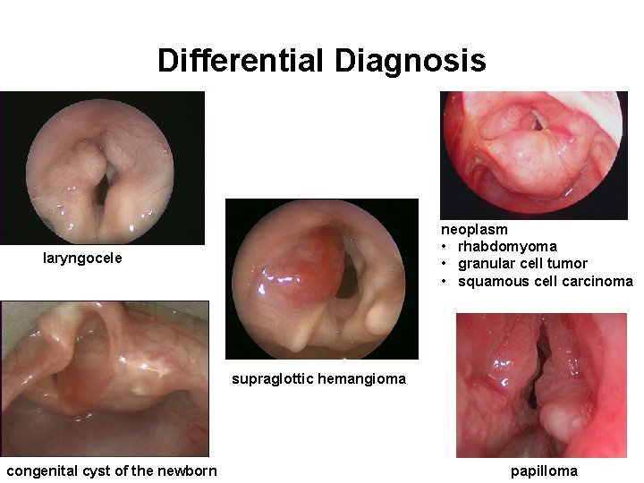 Differential Diagnosis neoplasm • rhabdomyoma • granular cell tumor • squamous cell carcinoma laryngocele