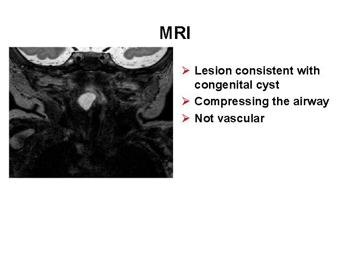 MRI Ø Lesion consistent with congenital cyst Ø Compressing the airway Ø Not vascular