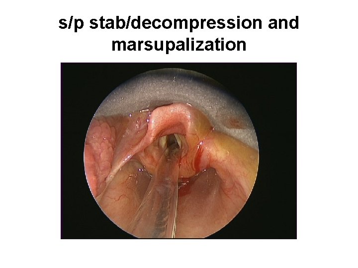 s/p stab/decompression and marsupalization 