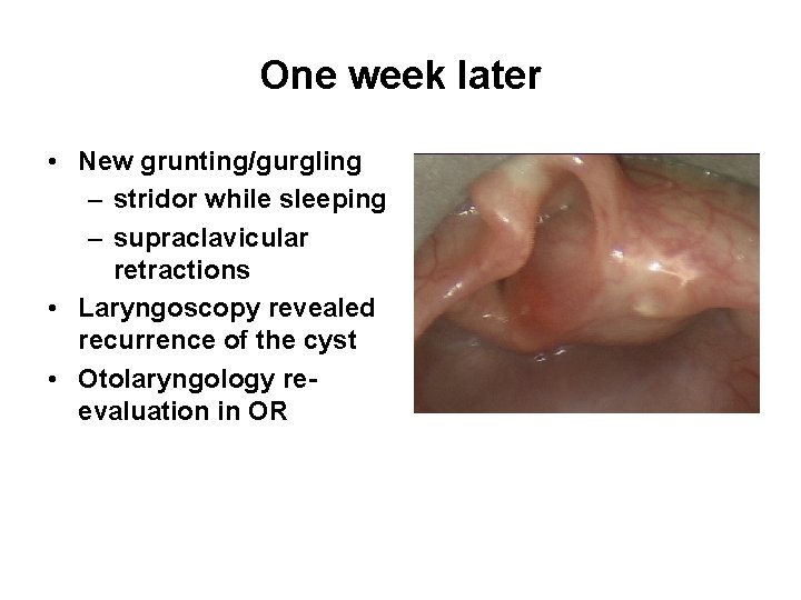One week later • New grunting/gurgling – stridor while sleeping – supraclavicular retractions •