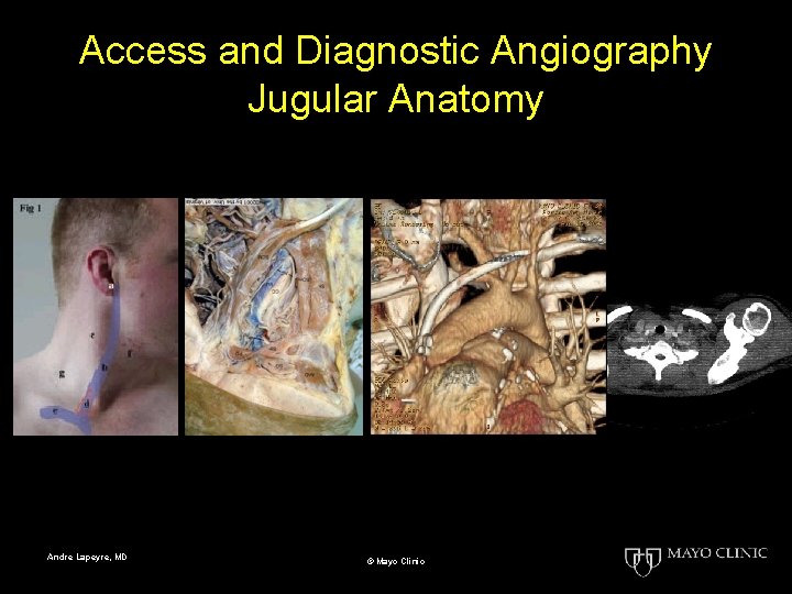 Access and Diagnostic Angiography Jugular Anatomy Andre Lapeyre, MD © Mayo Clinic 