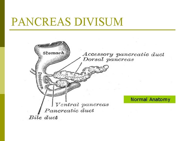 PANCREAS DIVISUM Normal Anatomy 