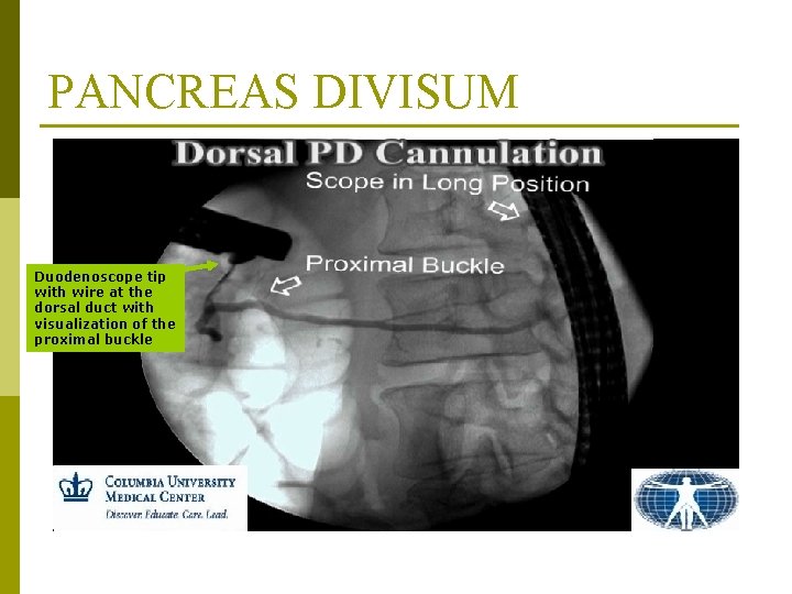 PANCREAS DIVISUM Duodenoscope tip with wire at the dorsal duct with visualization of the