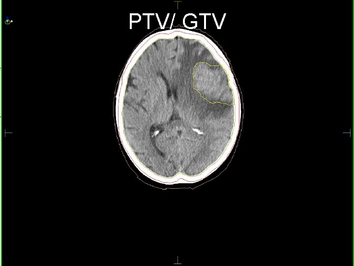 PTV/ GTV fektetés maszkrögzítés re. CT jelölések képfúzió topo. CT GTV 1 rizikószervek PTV