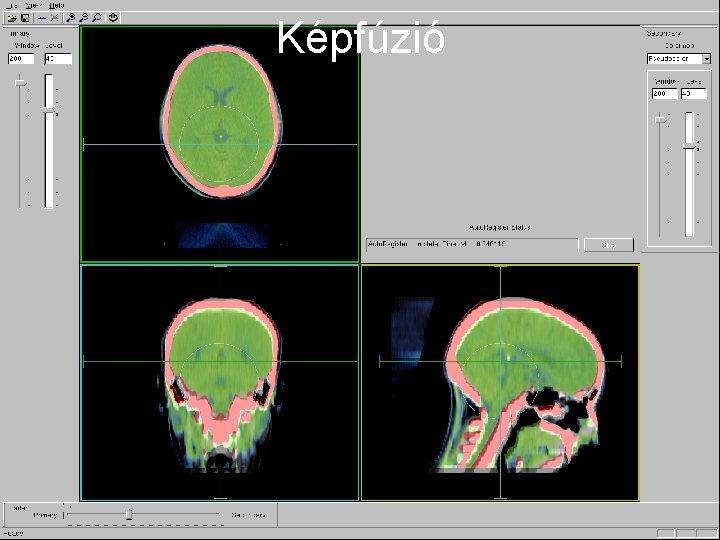 Képfúzió fektetés maszkrögzítés re. CT jelölések képfúzió topo. CT GTV 1 rizikószervek PTV 1