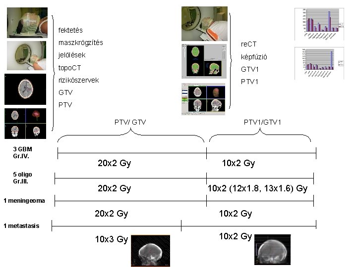 fektetés maszkrögzítés re. CT jelölések képfúzió topo. CT GTV 1 rizikószervek PTV 1 GTV