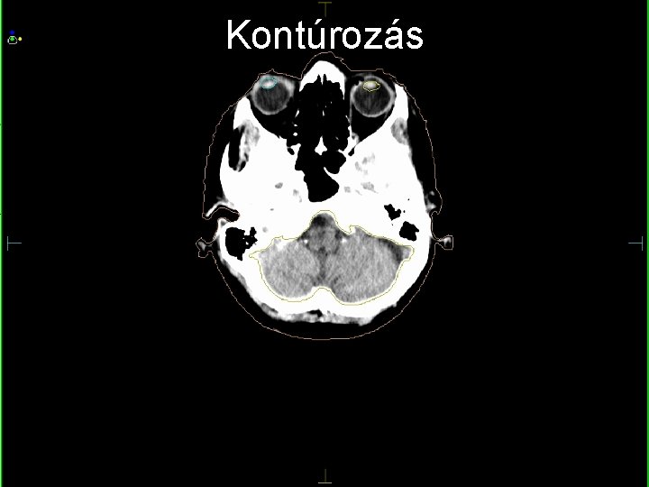 Kontúrozás fektetés maszkrögzítés re. CT jelölések képfúzió topo. CT GTV 1 rizikószervek PTV 1