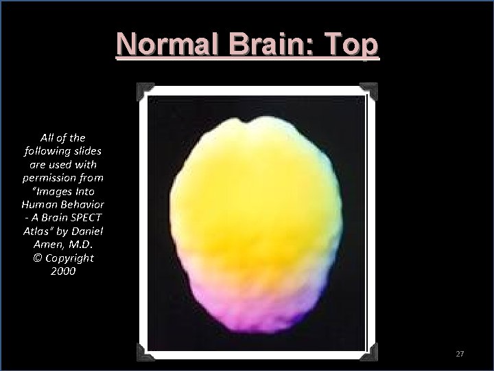 Normal Brain: Top All of the following slides are used with permission from “Images
