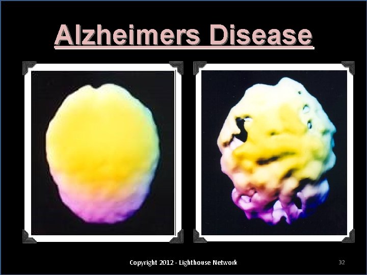 Alzheimers Disease Copyright 2012 - Lighthouse Network 32 