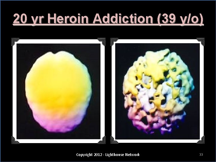 20 yr Heroin Addiction (39 y/o) Copyright 2012 - Lighthouse Network 33 