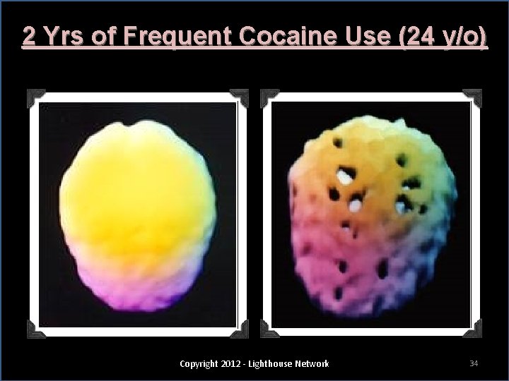 2 Yrs of Frequent Cocaine Use (24 y/o) Copyright 2012 - Lighthouse Network 34
