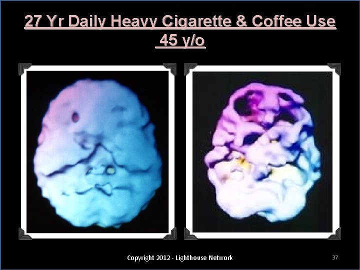 27 Yr Daily Heavy Cigarette & Coffee Use 45 y/o Copyright 2012 - Lighthouse