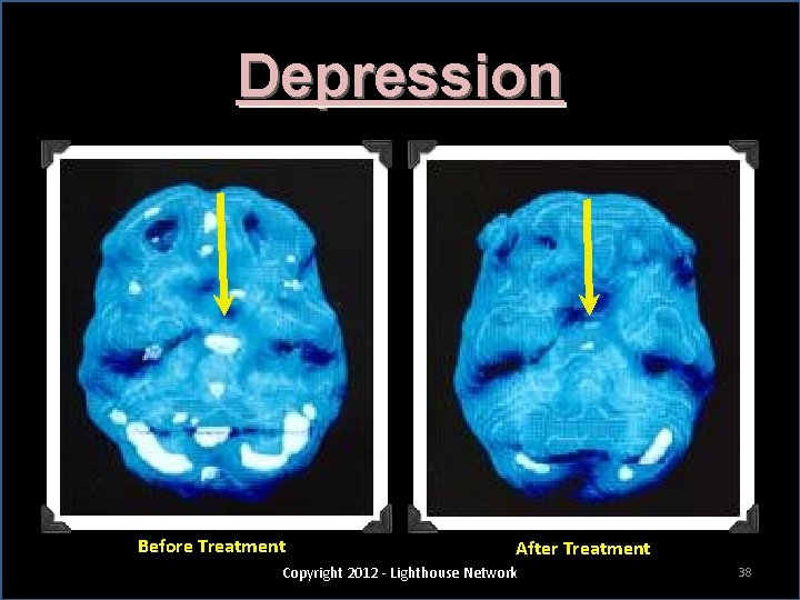 Depression Before Treatment After Treatment Copyright 2012 - Lighthouse Network 38 