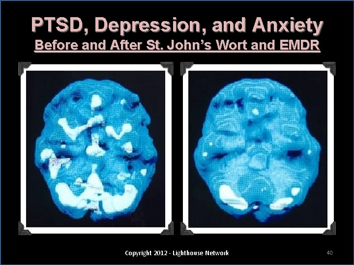 PTSD, Depression, and Anxiety Before and After St. John’s Wort and EMDR Copyright 2012
