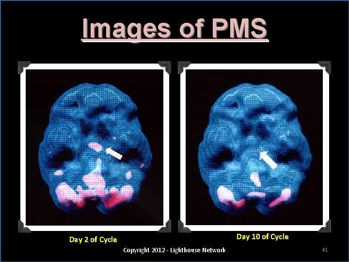 Images of PMS Day 2 of Cycle (Worst Time) Copyright 2012 - Lighthouse Network