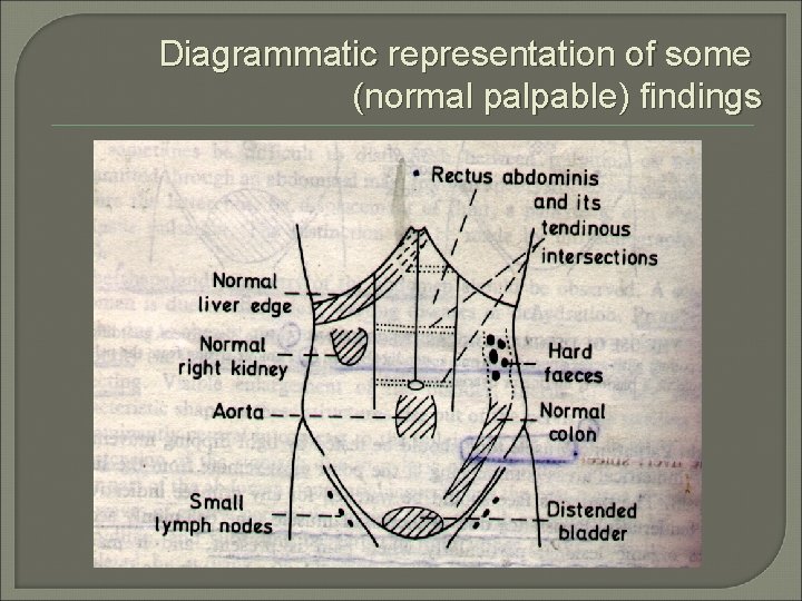 Diagrammatic representation of some (normal palpable) findings 