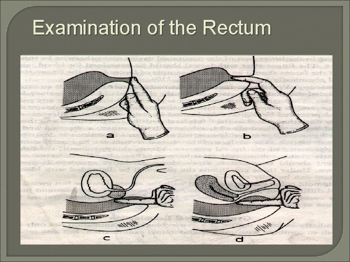 Examination of the Rectum 