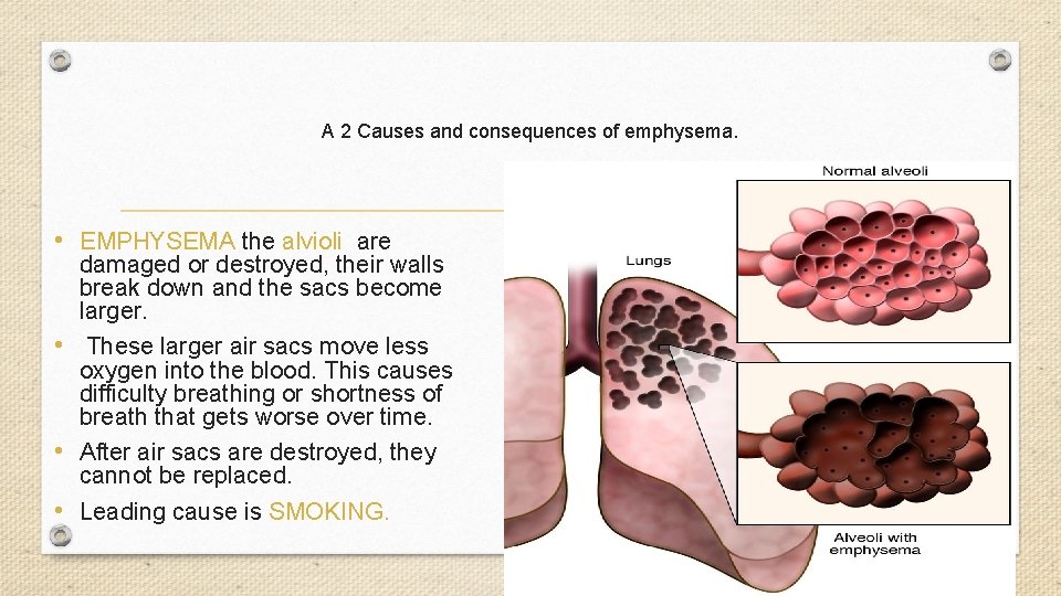 A 2 Causes and consequences of emphysema. • EMPHYSEMA the alvioli are damaged or