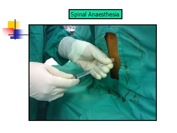 Spinal Anaesthesia 