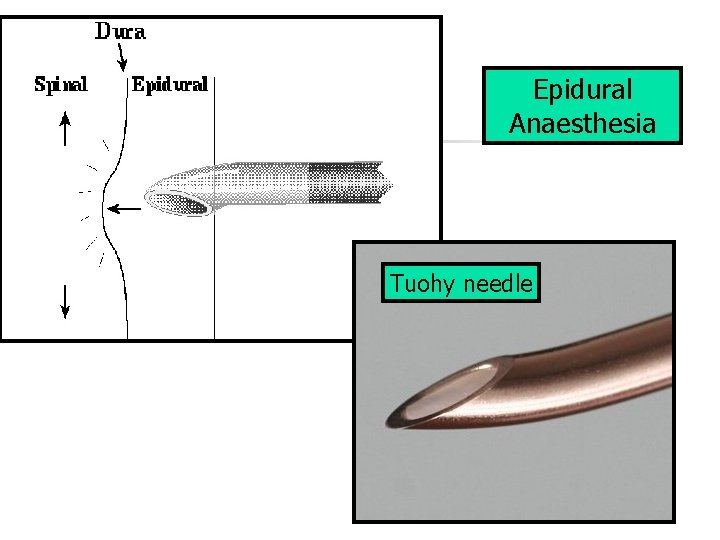 Epidural Anaesthesia Tuohy needle 