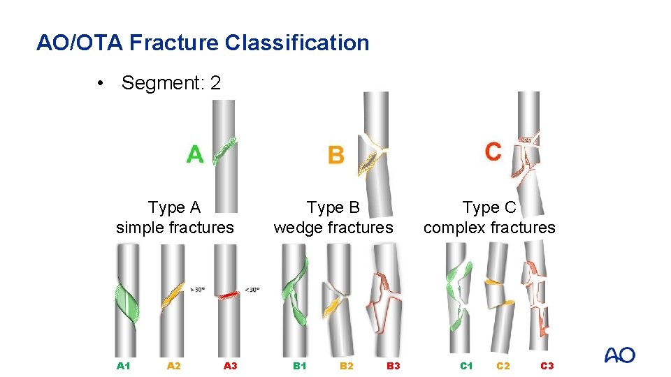 AO/OTA Fracture Classification • Segment: 2 Type A simple fractures A 1 A 2