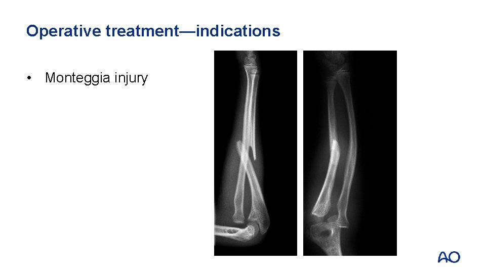 Operative treatment—indications • Monteggia injury 