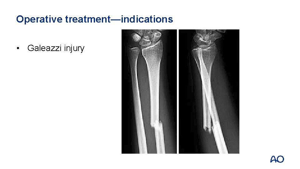 Operative treatment—indications • Galeazzi injury 