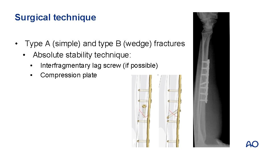 Surgical technique • Type A (simple) and type B (wedge) fractures • Absolute stability