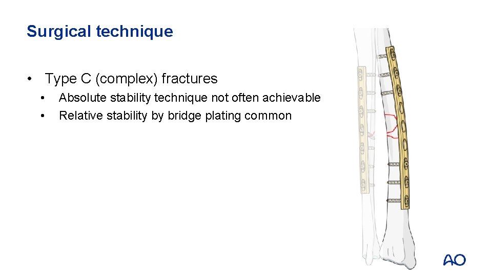 Surgical technique • Type C (complex) fractures • • Absolute stability technique not often