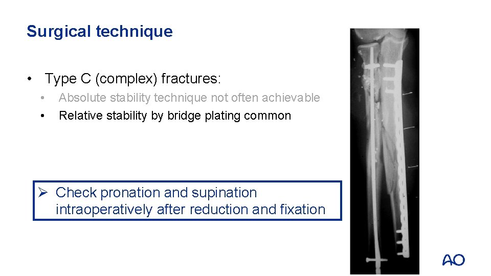 Surgical technique • Type C (complex) fractures: • • Absolute stability technique not often