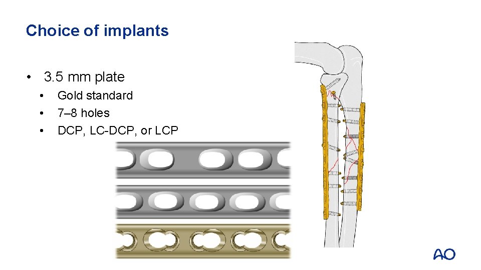 Choice of implants • 3. 5 mm plate • • • Gold standard 7–
